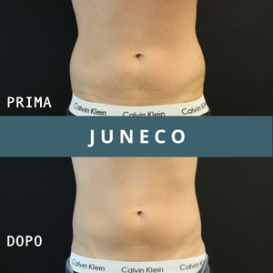 Coolsculpting prima e dopo