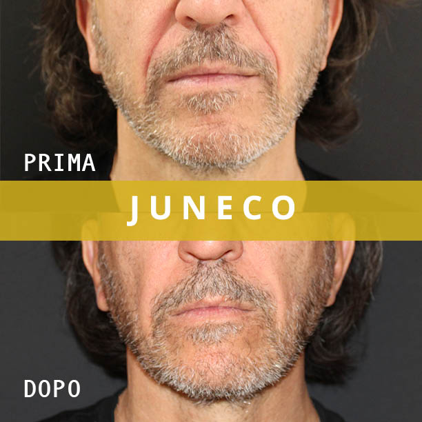 prima dopo filler rughe nasogeniene