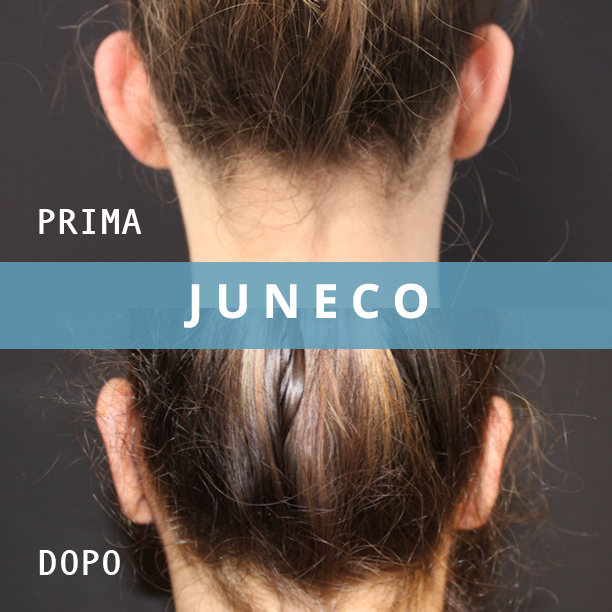 otoplastica risultati prima e dopo