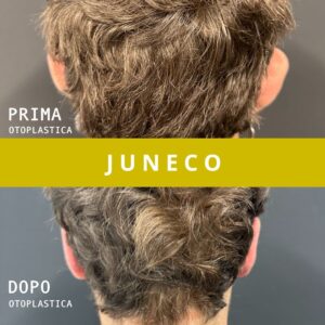 Otoplastica Juneco